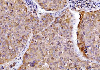 IHC staining of FFPE human liver cancer tissue with AHSA1 antibody. HIER: boil tissue sections in pH8 EDTA for 20 min and allow to cool before testing.