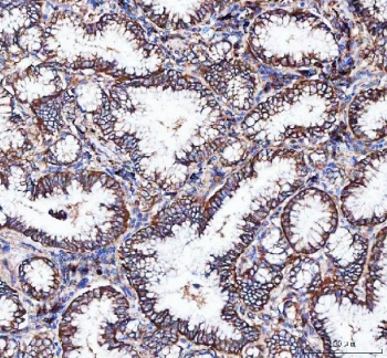 IHC staining of FFPE human lung adenocarcinoma tissue with Integrin alpha 3 antibody. HIER: boil tissue sections in pH8 EDTA for 20 min and allow to cool before testing.