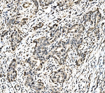IHC staining of FFPE human renal pelvis squamous metaplasia tissue with c-Jun antibody. HIER: boil tissue sections in pH8 EDTA for 20 min and allow to cool before testing.