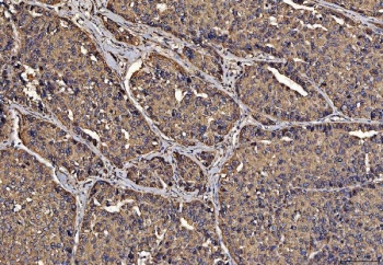 IHC staining of FFPE human liver cancer tissue with PDIA6 antibody. HIER: boil tissue sections in pH8 EDTA for 20 min and allow to cool before testing.