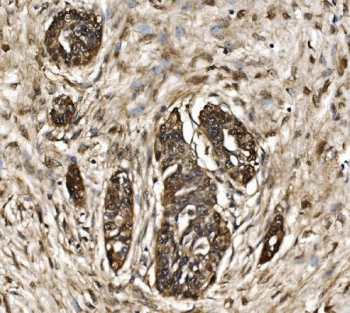 IHC staining of FFPE human cervical intraepithelial neoplasia tissue with Proteasome 20S beta 7 antibody. HIER: boil tissue sections in pH8 EDTA for 20 min and allow to cool before testing.