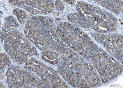 IHC staining of FFPE human liver cancer tissue with Poliovirus Receptor antibody. HIER: boil tissue sections in pH8 EDTA for 20 min and allow to cool before testing.