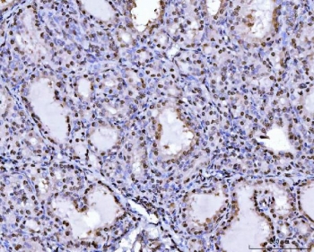 IHC staining of FFPE human poison impregnated thyroid gland tissue with SUB1 antibody. HIER: boil tissue sections in pH8 EDTA for 20 min and allow to cool before testing.