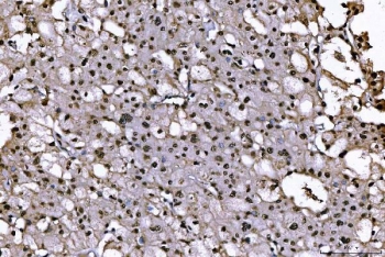 IHC staining of FFPE human renal cell carcinoma tissue with SUB1 antibody. HIER: boil tissue sections in pH8 EDTA for 20 min and allow to cool before testing.