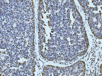 IHC staining of FFPE human bladder epithelial carcinoma tissue with p53 binding protein 1 antibody. HIER: boil tissue sections in pH8 EDTA for 20 min and allow to cool before testing.