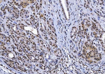 IHC staining of FFPE human pancreatic ductal adenocarcinoma tissue with YY1 antibody. HIER: boil tissue sections in pH8 EDTA for 20 min and allow to cool before testing.
