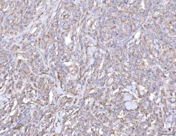 IHC staining of FFPE human lymphoma tissue with PLP2 antibody. HIER: boil tissue sections in pH8 EDTA for 20 min and allow to cool before testing.