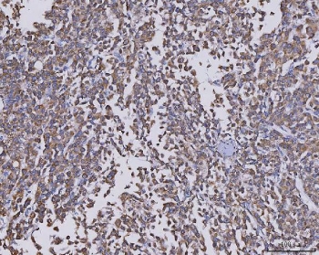IHC staining of FFPE human liver cancer tissue with CCL14 antibody. HIER: boil tissue sections in pH8 EDTA for 20 min and allow to cool before testing.~