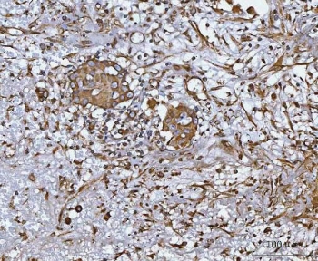 IHC staining of FFPE human breast cancer tissue with CCL14 antibody. HIER: boil tissue sections