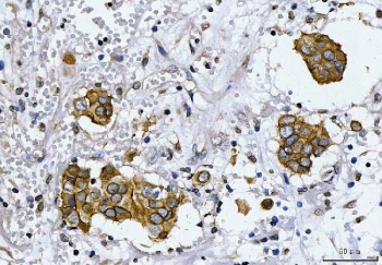 IHC staining of FFPE human breast cancer tissue with ERBB2 antibody. HIER: boil tissue sections in pH8 EDTA for 20 min and allow to cool before testing.~