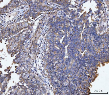 IHC staining of FFPE human bladder epithelial carcinoma tissue with MUC1 antibody. HIER: boil tissue sections in pH8 EDTA for 20 min and allow to cool before testing.