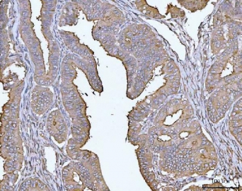 IHC staining of FFPE human endometrial cancer tissue with MUC1 antibody. HIER: boil tissue sections in pH8 EDTA for 20 min and allow to cool before testing.