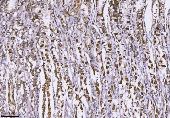 IHC staining of FFPE human gastric cancer tissue with Mucin 2 antibody. HIER: boil tissue sections in pH8 EDTA for 20 min and allow to cool before testing.