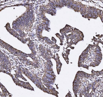IHC staining of FFPE human rectal cancer tissue with Mucin 2 antibody. HIER: boil tissue sections in pH8 EDTA for 20 min and allow to cool before testing.