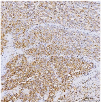 IHC staining of FFPE human melanoma tissue with PPP1R15A antibody. HIER: boil tissue sections in pH8 EDTA for 20 min and allow to cool before testing.~