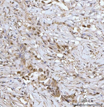 IHC staining of FFPE human breast cancer tissue with Protein arginine N-methyltransferase 5 antibody. HIER: boil tissue sections in pH8 EDTA for 20 min and allow to cool before testing.