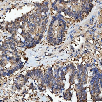 IHC staining of FFPE human rectal cancer tissue with Protein arginine N-methyltransferase 5 antibody. HIER: boil tissue sections in pH8 EDTA for 20 min and allow to cool before testing.