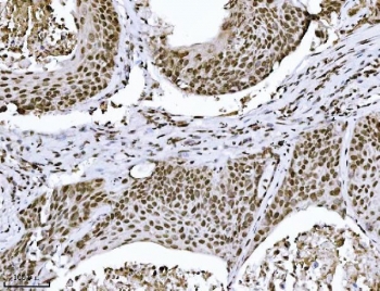IHC staining of FFPE human squamous cell lung carcinoma tissue with KPNB1 antibody. HIER: boil tissue sections in pH8 EDTA for 20 min and allow to cool before testing.