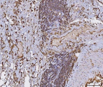 IHC staining of FFPE human rectal cancer tissue with HLA-DRA antibody. HIER: boil tissue sections in pH8 EDTA for 20 min and allow to cool before testing.