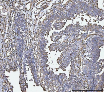 IHC staining of FFPE human bladder epithelial carcinoma tissue with HLA-DRA antibody. HIER: boil tissue sections in pH8 EDTA for 20 min and allow to cool before testing.