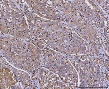 IHC staining of FFPE human hepatocellular carcinoma tissue with HLA-DRA antibody. HIER: boil tissue sections in pH8 EDTA for 20 min and allow to cool before testing.