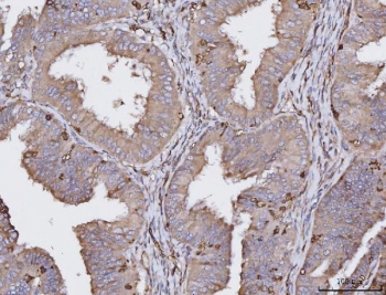 IHC staining of FFPE human endometrial cancer tissue with HLA-DRA antibody. HIER: boil tissue sections in pH8 EDTA for 20 min and allow to cool before testing.