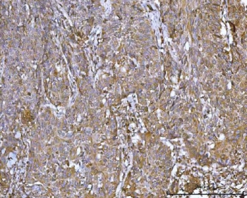 IHC staining of FFPE human laryngeal squamous cell carcinoma tissue with CCDC115 antibody. HIER: boil tissue sections in pH8 EDTA for 20 min and allow to cool before testing.