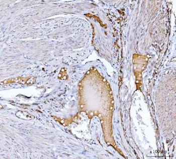 IHC staining of FFPE human endometrial cancer tissue with Clusterin antibody. HIER: boil tissue sections in pH8 EDTA for 20 min and allow to cool before testing.~