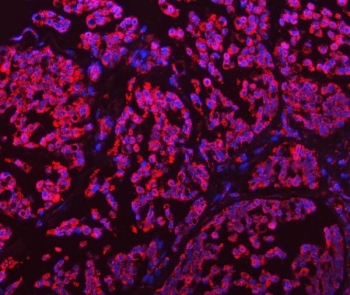 Immunofluorescent staining of FFPE human breast cancer tissue with GLUD1/2 antibody (red) and DAPI nuclear stain (blue). HIER: boil tissue sections in pH8 EDTA for 20 min and allow to cool before testing.