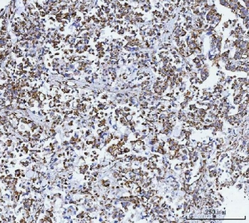 IHC staining of FFPE human gastric carcinoma tissue with GLUD1/2 antibody. HIER: boil tissue sections in pH8 EDTA for 20 min and allow to cool before testing.