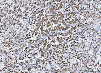 IHC staining of FFPE human liver cancer tissue with GLUD1/2 antibody. HIER: boil tissue sections in pH8 EDTA for 20 min and allow to cool before testing.