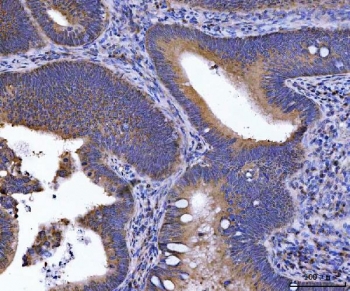 IHC staining of FFPE human rectal cancer tissue with GOLGA3 antibody. HIER: boil tissue sections in pH8 EDTA for 20 min and allow to cool before testing.