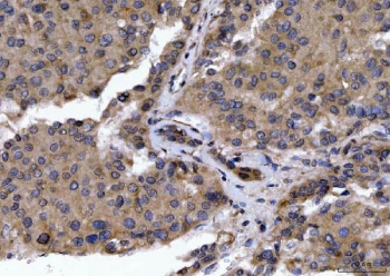 IHC staining of FFPE human liver cancer tissue with GOLGA3 antibody. HIER: boil tissue sections in pH8 EDTA for 20 min and allow to cool before testing.
