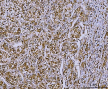 IHC staining of FFPE human liver cancer tissue with SLC22A7 antibody. HIER: boil tissue sections in pH8 EDTA for 20 min and allow to cool before testing.