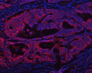 Immunofluorescent staining of FFPE human colon cancer tissue with ATP5A1 antibody (red) and DAPI nuclear stain (blue). HIER: steam section in pH8 EDTA for 20 min.