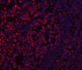 Immunofluorescent staining of FFPE human lung cancer tissue with ECHS1 antibody (red) and DAPI nuclear stain (blue). HIER: steam section in pH8 EDTA buffer for 20 min.
