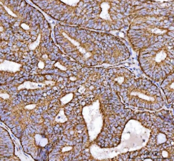 IHC staining of FFPE human endometrial adenocarcinoma tissue with NDUFS2 antibody. HIER: boil tissue sections in pH8 EDTA for 20 min and allow to cool before testing.