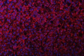 Immunofluorescent staining of FFPE human liver cancer tissue with NDUFS2 antibody (red) and DAPI nuclear stain (blue). HIER: steam section in pH8 EDTA buffer for 20 min.