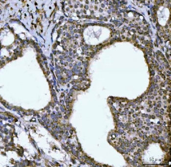 IHC staining of FFPE human breast cancer tissue with NDUFS6 antibody. HIER: boil tissue sections in pH8 EDTA for 20 min and allow to cool before testing.