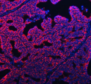 Immunofluorescent staining of FFPE human ovarian cancer tissue with APP-1 antibody (red) and DAPI nuclear stain (blue). HIER: steam section in pH8 EDTA buffer for 20 min.