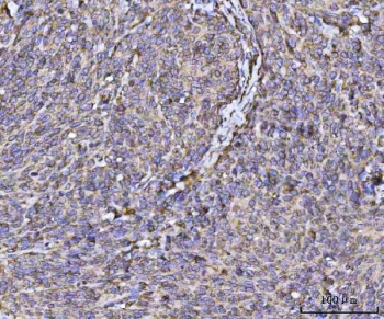IHC staining of FFPE human cervical cancer tissue with RPL36 antibody. HIER: boil tissue sections in pH8 EDTA for 20 min and allow to cool before testing.