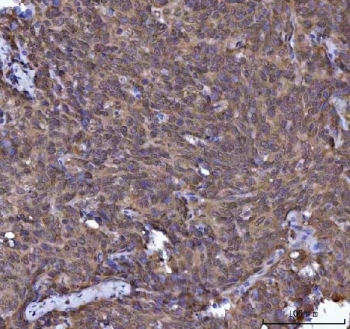 IHC staining of FFPE human cervical cancer tissue with TIP3 antibody. HIER: boil tissue sections in pH8 EDTA for 20 min and allow to cool before testing.