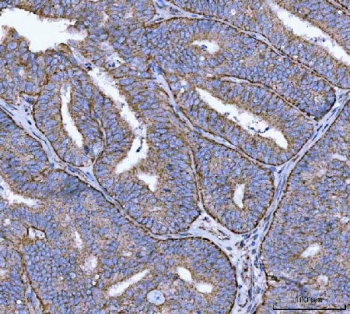 IHC staining of FFPE human endometrial adenocarcinoma tissue with CANX antibody. HIER: boil tissue sections in pH8 EDTA for 20 min and allow to cool before testing.