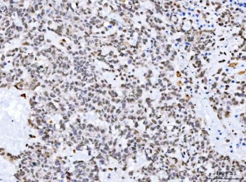 IHC staining of FFPE human breast cancer tissue with STK15 antibody. HIER: boil tissue sections in pH8 EDTA for 20 min and allow to cool before testing.
