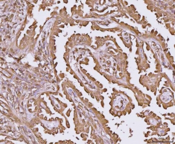 IHC staining of FFPE human lung cancer tissue with YWHAE antibody. HIER: boil tissue sections in pH8 EDTA for 20 min and allow to cool before testing.