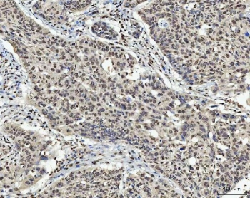 IHC staining of FFPE human laryngeal squamous cell carcinoma tissue with TCF-8 antibody. HIER: boil tissue sections in pH8 EDTA for 20 min and allow to cool before testing.