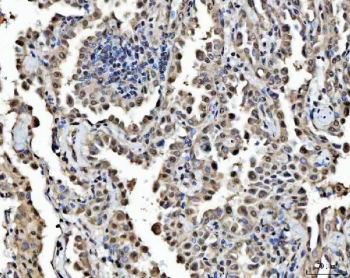 IHC staining of FFPE human lung adenocarcinoma tissue with FIP1L1 antibody. HIER: boil tissue sections in pH8 EDTA for 20 min and allow to cool before testing.