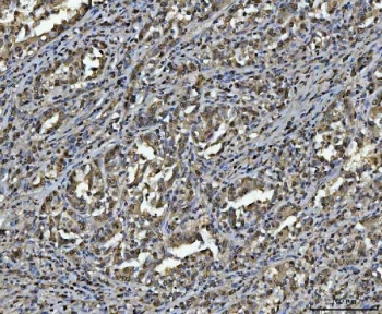 IHC staining of FFPE human gastric carcinoma tissue with hnRNP U antibody. HIER: boil tissue sections in pH8 EDTA for 20 min and allow to cool before testing.
