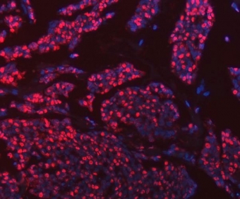 Immunofluorescent staining of FFPE human breast cancer tissue with hnRNP U antibody (red) and DAPI nuclear stain (blue). HIER: steam section in pH8 EDTA buffer for 20 min.