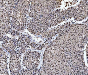 IHC staining of FFPE human hepatocellular carcinoma tissue with HNRPL antibody. HIER: boil tissue sections in pH8 EDTA for 20 min and allow to cool before testing.
